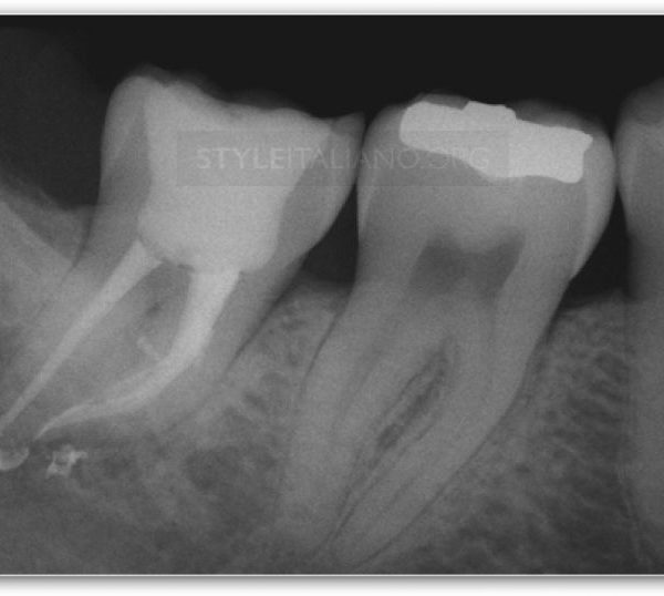 Decision Making in Endodontics