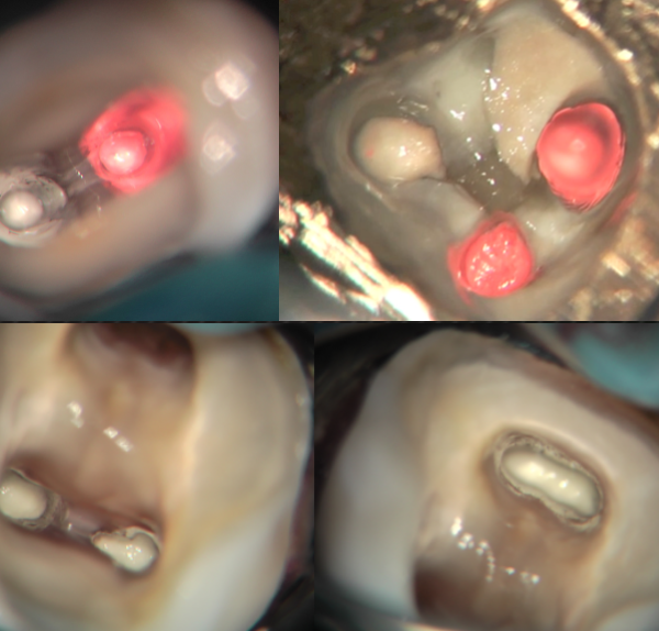 MTA placement in curved molars part 1: THE TECHNIQUE