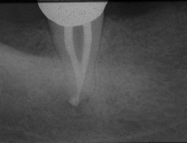 Third molars: extraction or endodontics?