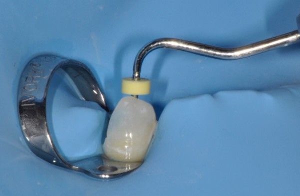 Root Canal Filling Systems: Warm Vertical Condensation