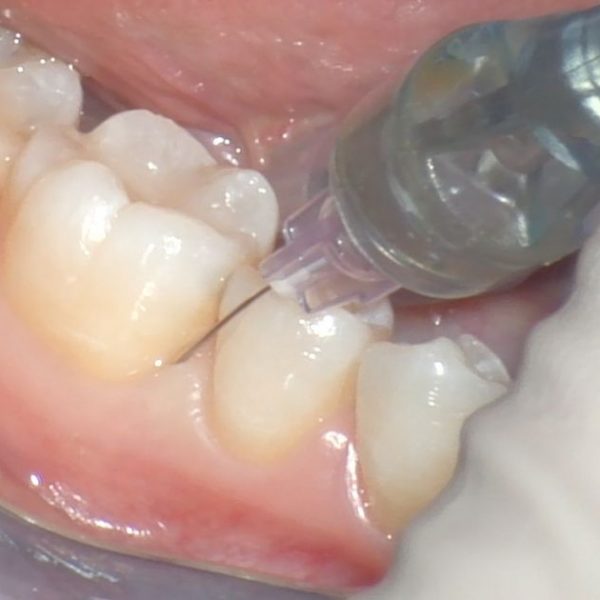 Single Tooth Anesthesia