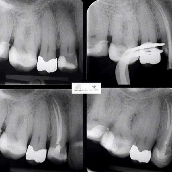 Endo-resto treatment of upper right first premolar.