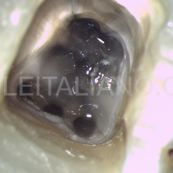 Middle Mesial Canal of the Mandibular First Molar: a case report