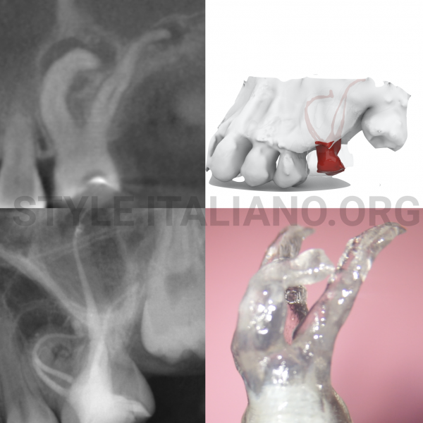 Print & Try - Endodontic management of a rare case of dilacerated maxillary first molar: case report and clinical strategy