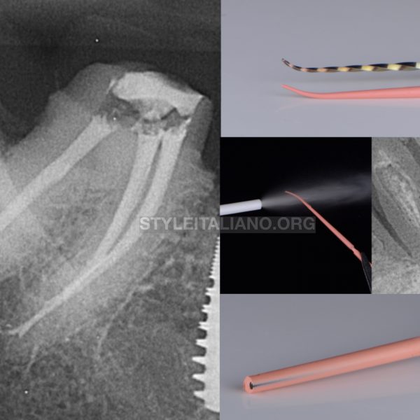 Obturation of root canals with impediments