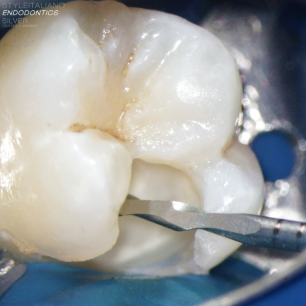 Conservative treatment of an upper molar