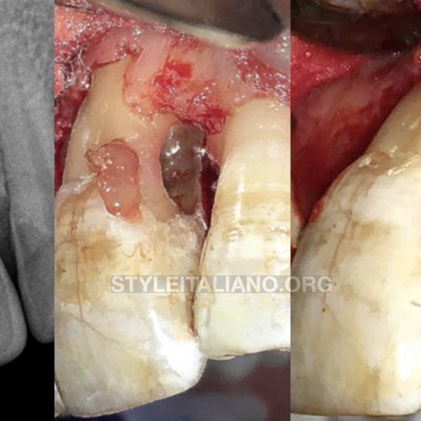 Invasive Cervical Resorption Part 2: Combined Non-surgical and surgical management
