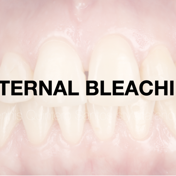 The use of internal bleaching in a non-vital tooth as a conservative approach