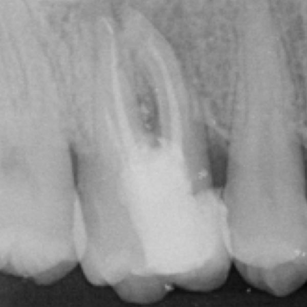 Management of a retreatment case with  multiple endodontic mishaps