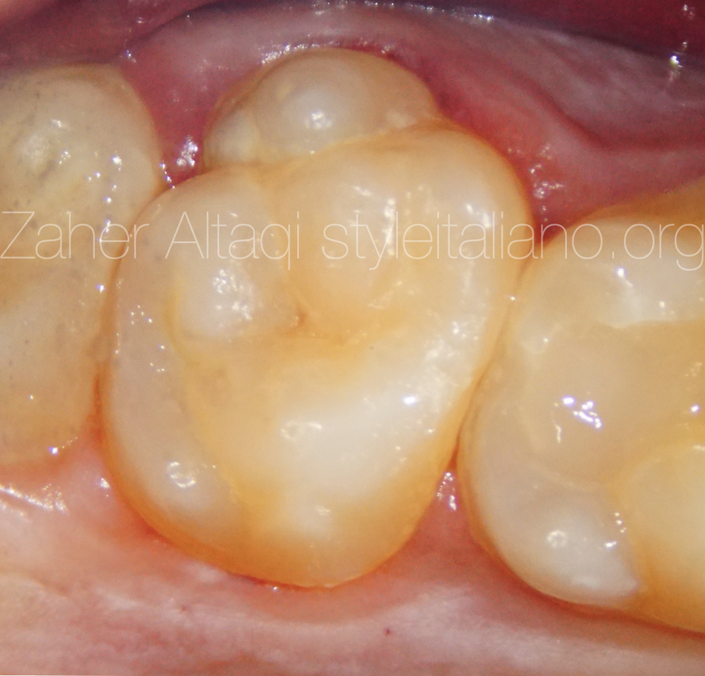 Unusual Upper Second Molar with 5 root canals - AbuMaizar Dental Roots  Clinic