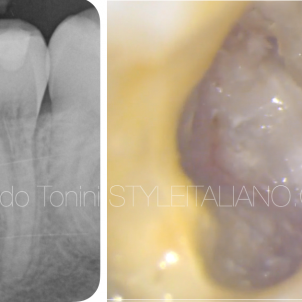 An external cervical resorption managed with MTA: 5 years follow up