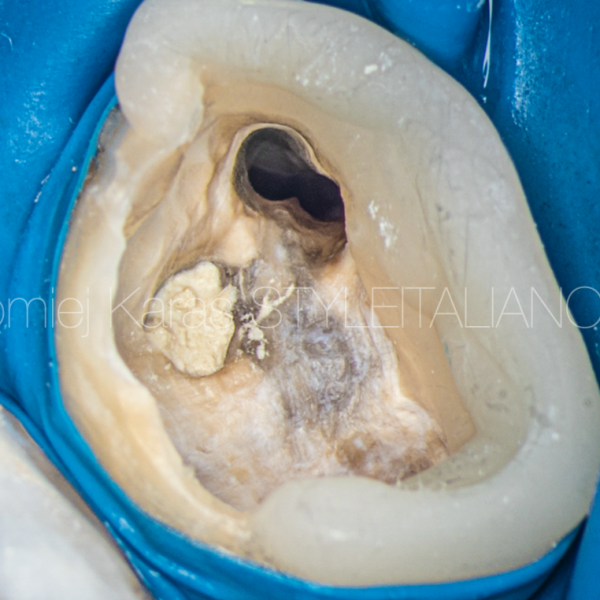 Root perforation management