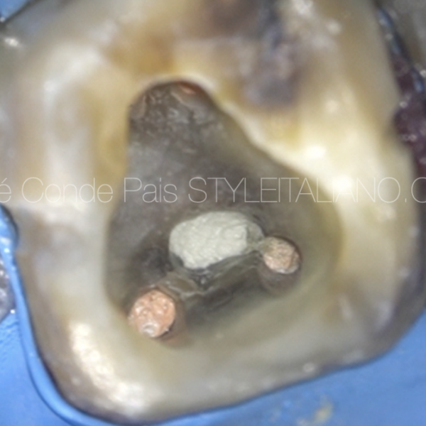 Management of Iatrogenic Furcal Perforation in tooth with obliterated root canal