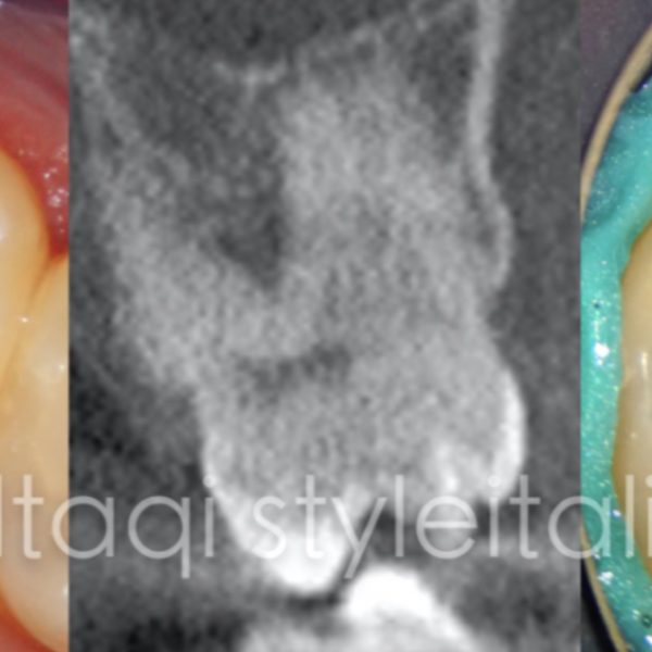 Unusual anatomy in upper second molar
