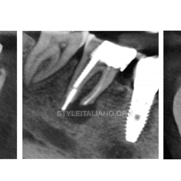 Triple MTA apical plug in second lower molar  with  overextended guttapercha