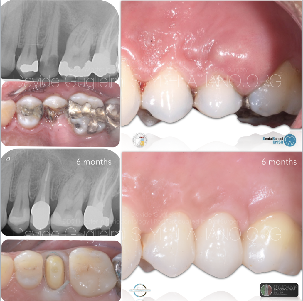 Interactions Between  Endodontics and Periodontics:  Part I