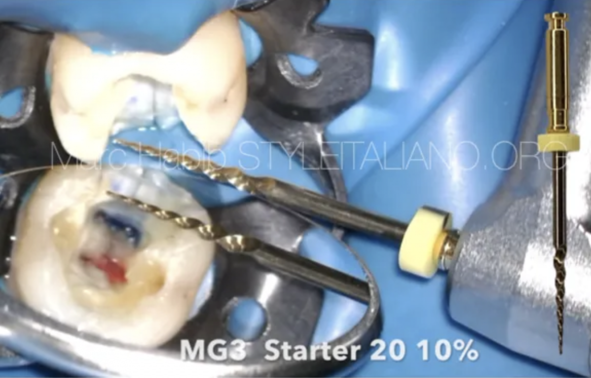 Cracked tooth syndrome - Style Italiano Endodontics