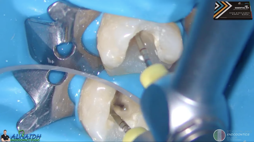Modification in canal preparation for long and narrow canals of lower first molar