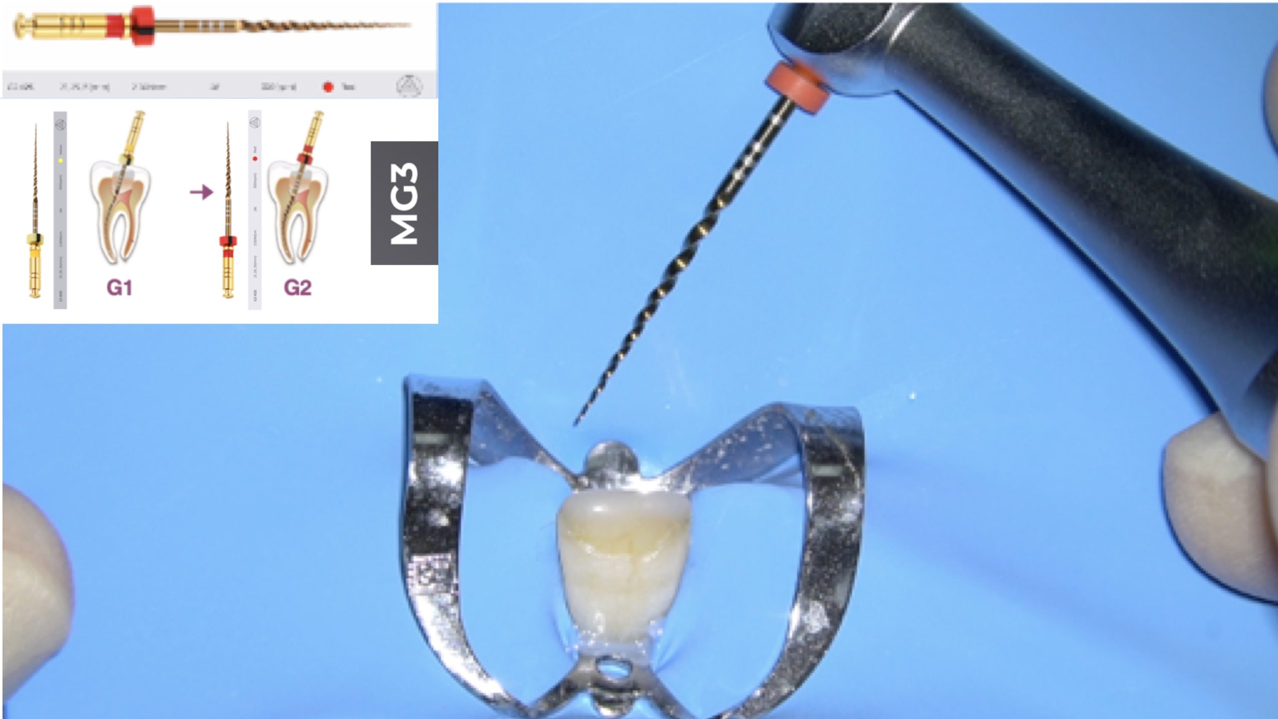 Endodontic Management of Maxillary Central Incisor with apical calcification