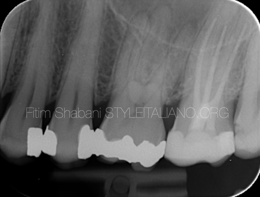 Cracked Teeth - St. Albert Endodontics