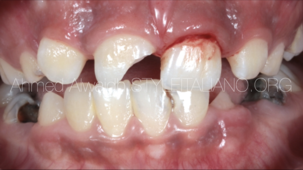 Vital Pulp Therapy: Part 1: Direct Pulp Capping for A Traumatic