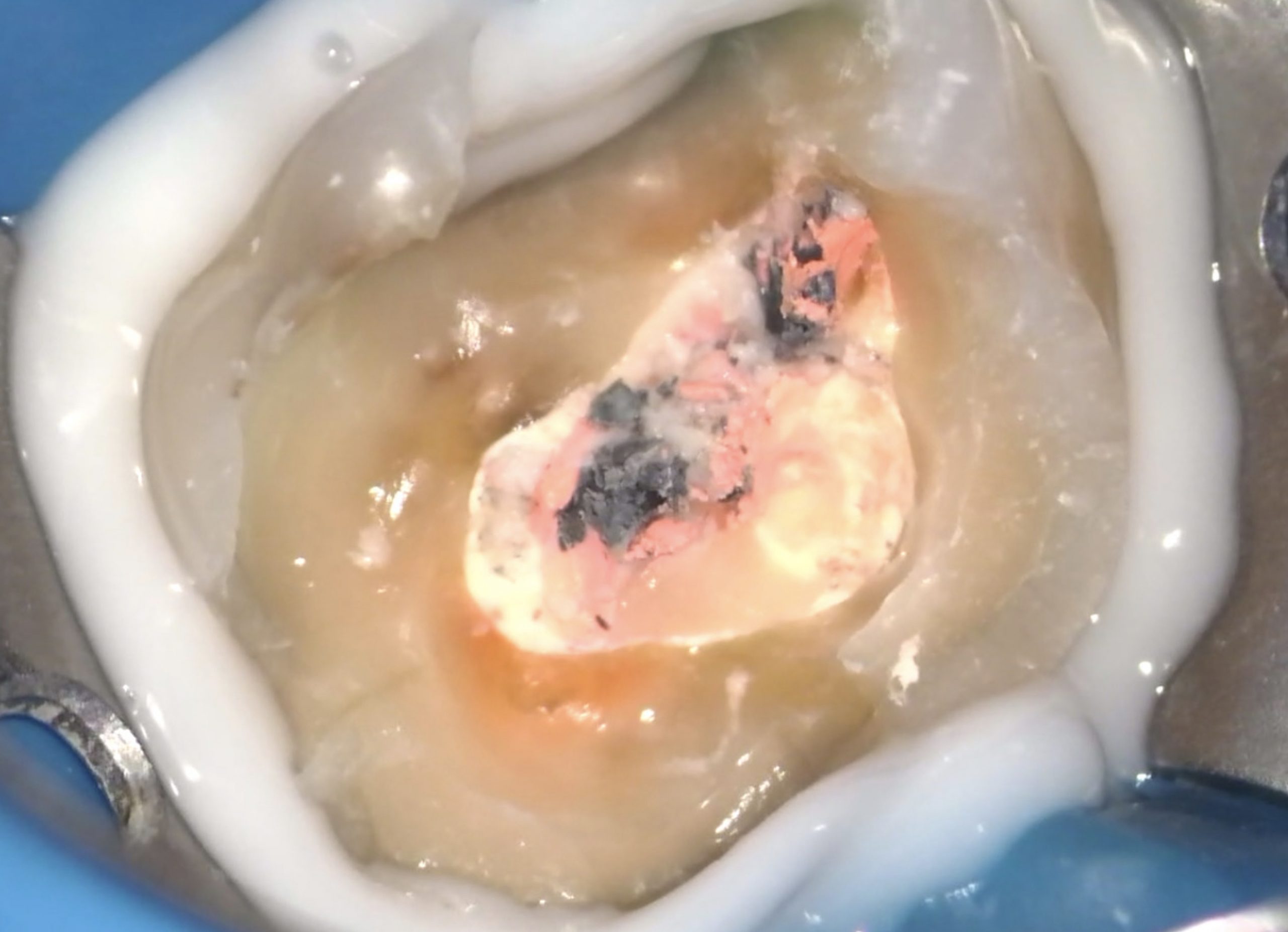Thermafil Retreatment of a right upper first molar