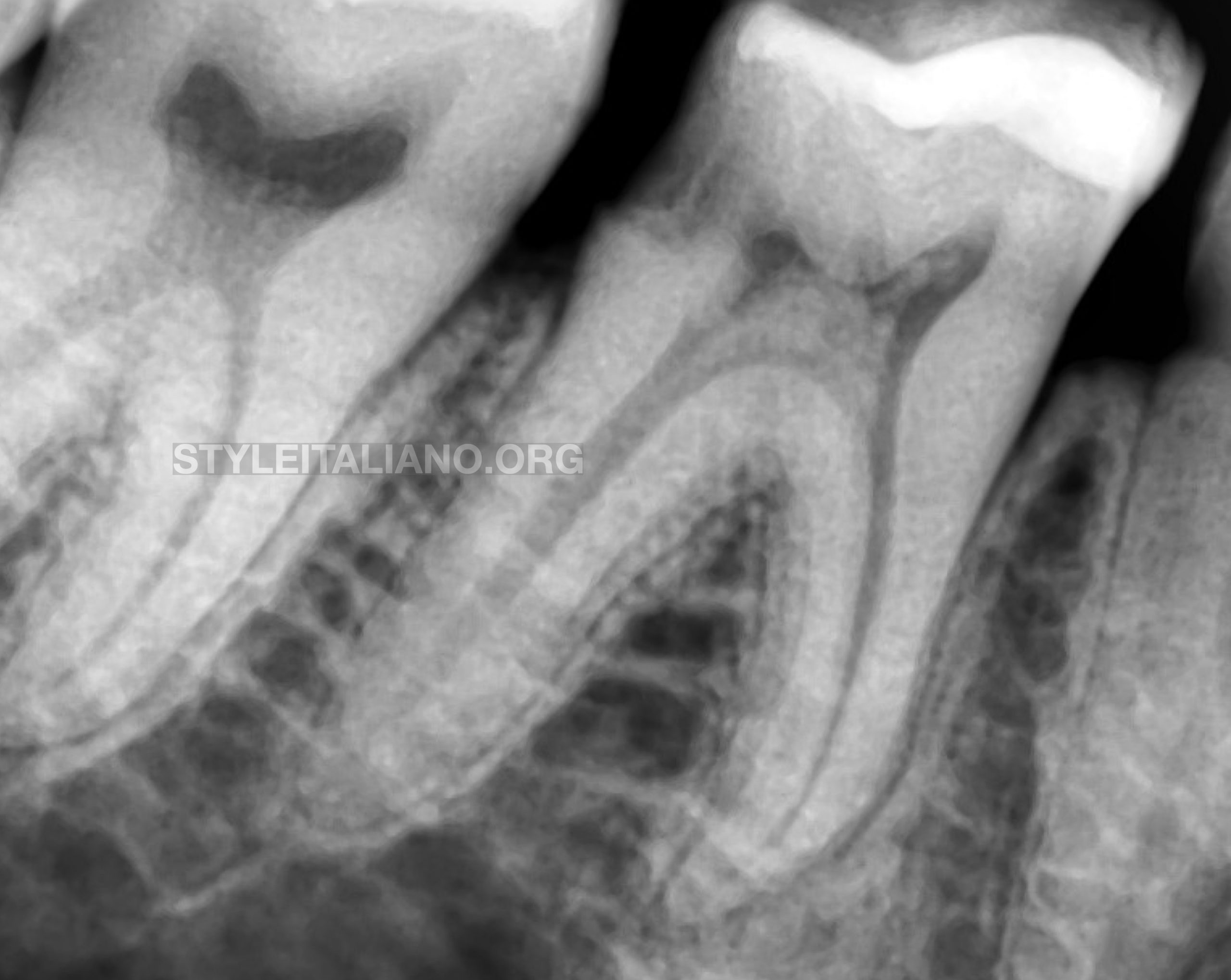 Endodontic management of a mandibular first molar with pulp stone obliterating  the floor of pulp chamber – a case report.