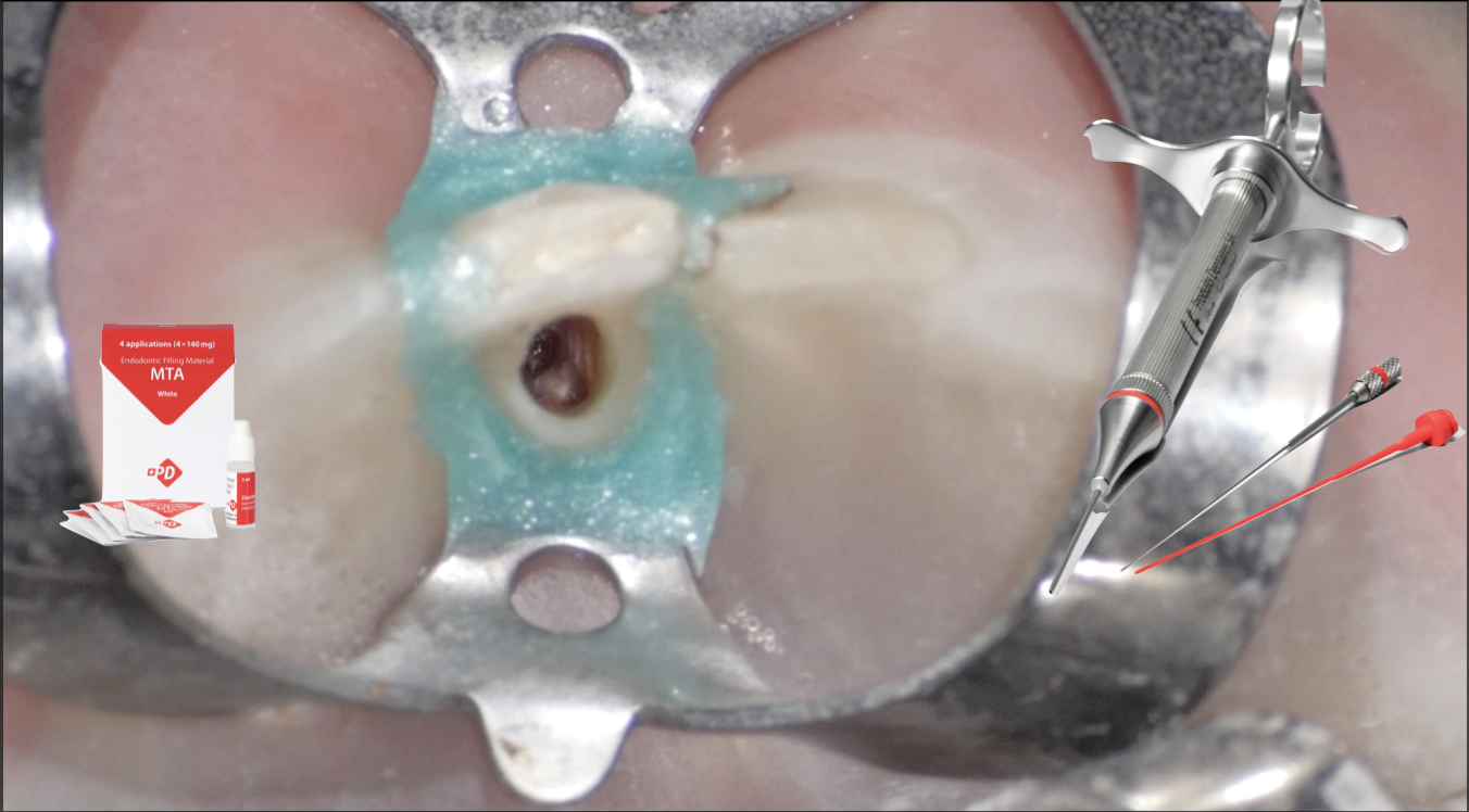 The management of a buccal perforation in a lower incisor
