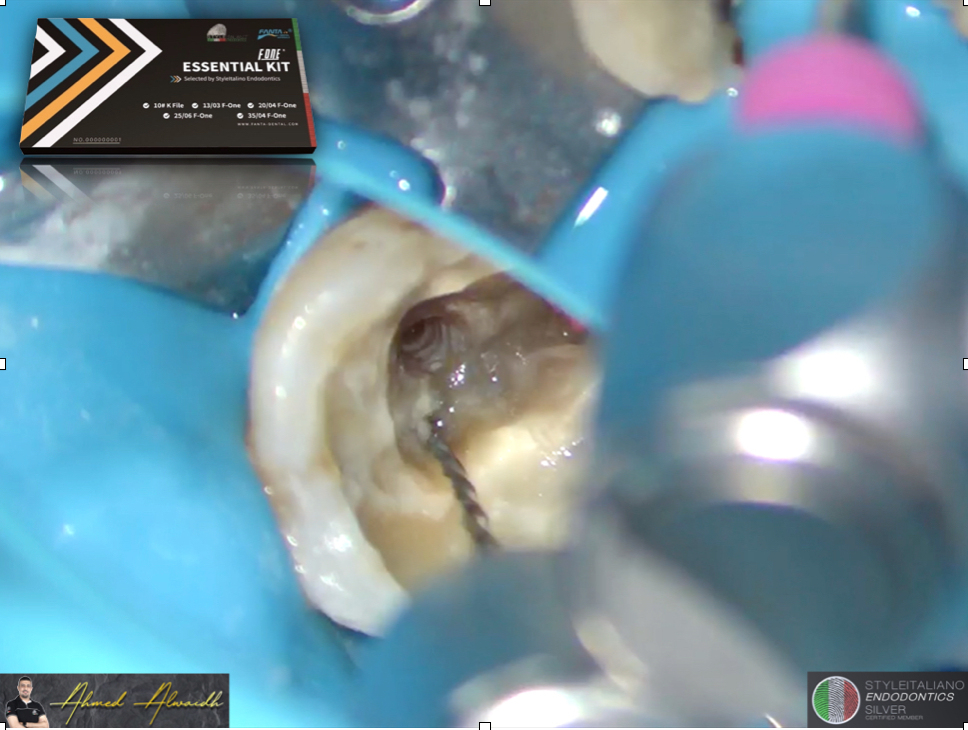 A Multi-Disciplinary Approach in Non-Surgical Re-treatment of Mandibular Right First Molar