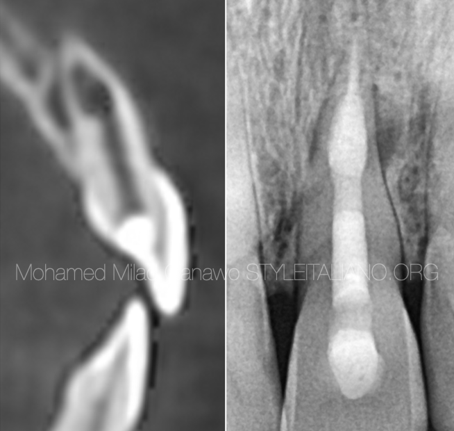 Management of internal root resorption in a maxillary central incisor