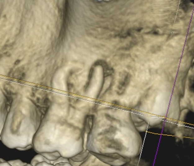 Save the bride: retreatment of a second upper molar with large lesion and sinus tract