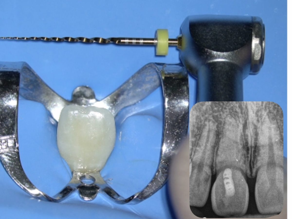 The State of the Art in Endodontics | MDPI Books