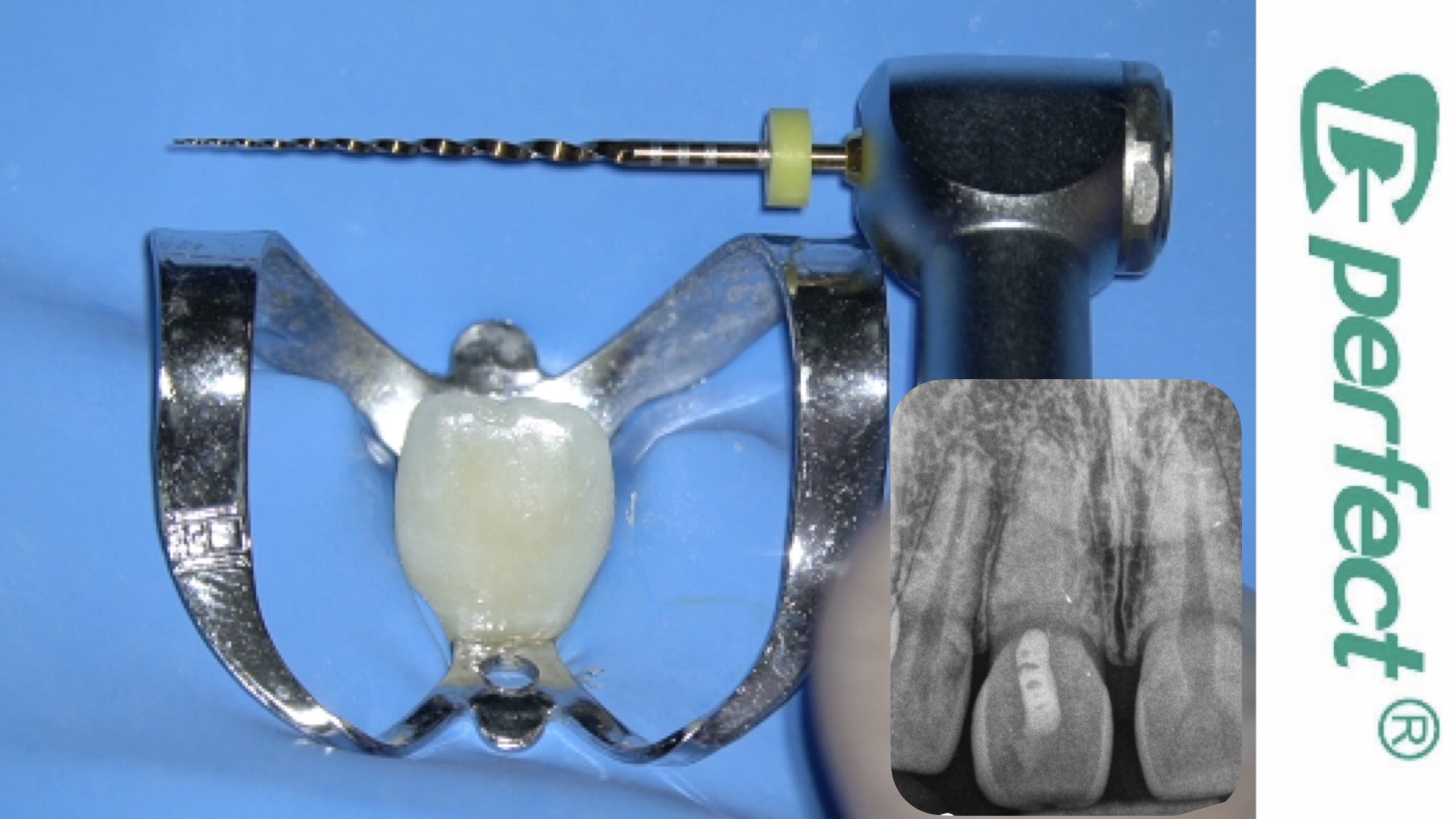 Management of Maxillary Central Incisor with Extreme Calcific Metamorphosis