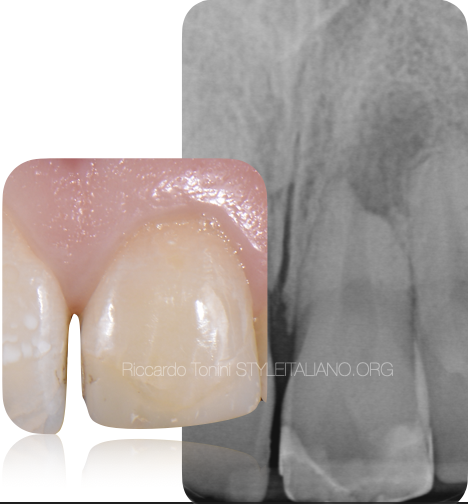 Endodontic treatment of an immature necrotic tooth