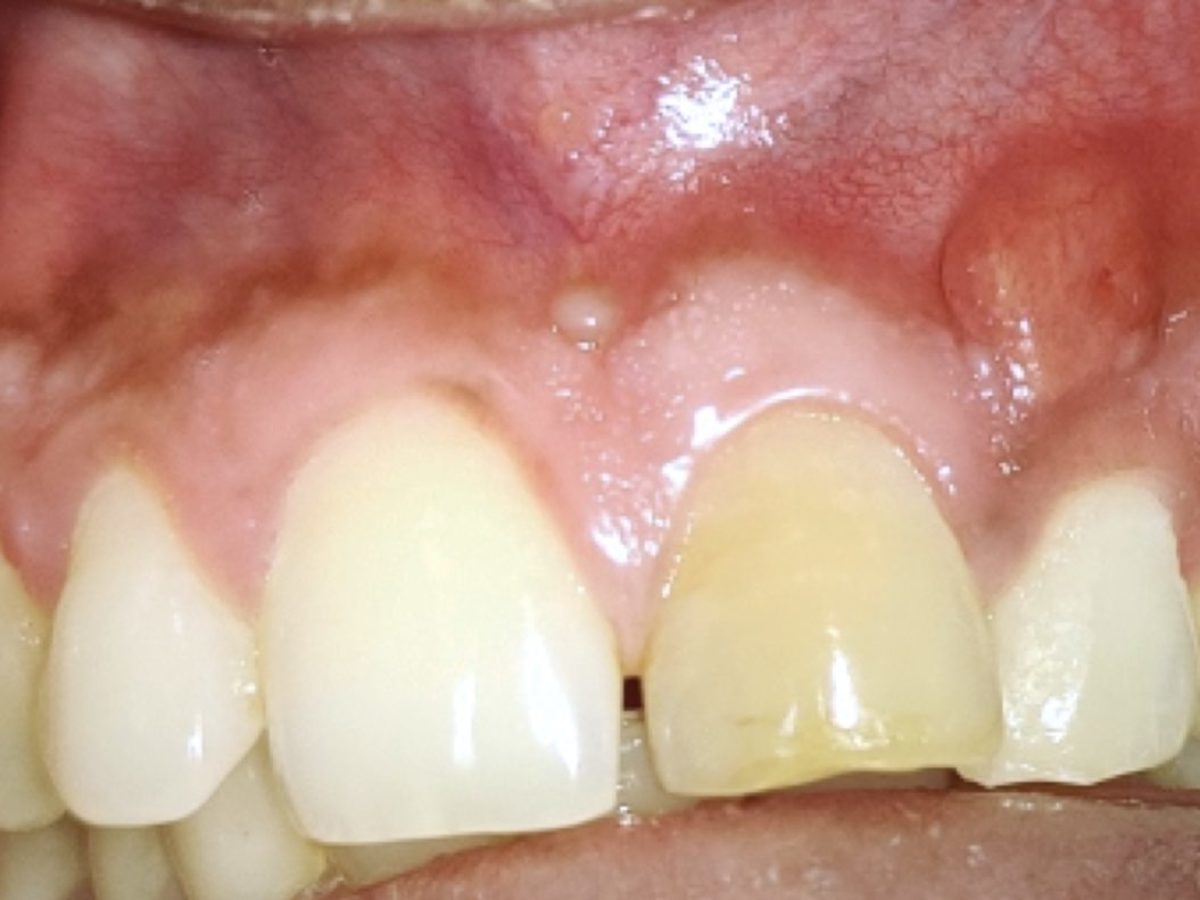 Efficient cleaning and proper sealing of root canals, the