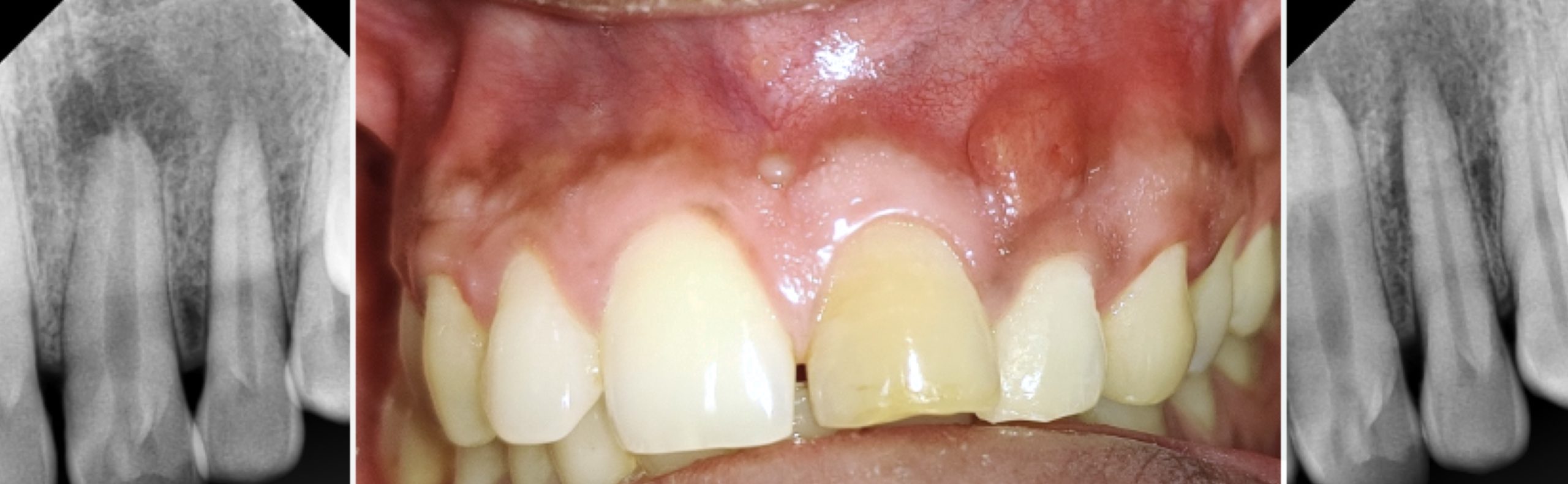 Efficient cleaning and proper sealing of root canals, the key to endodontic success- a case of  non-surgical endodontic management of tooth number 21 and 22.