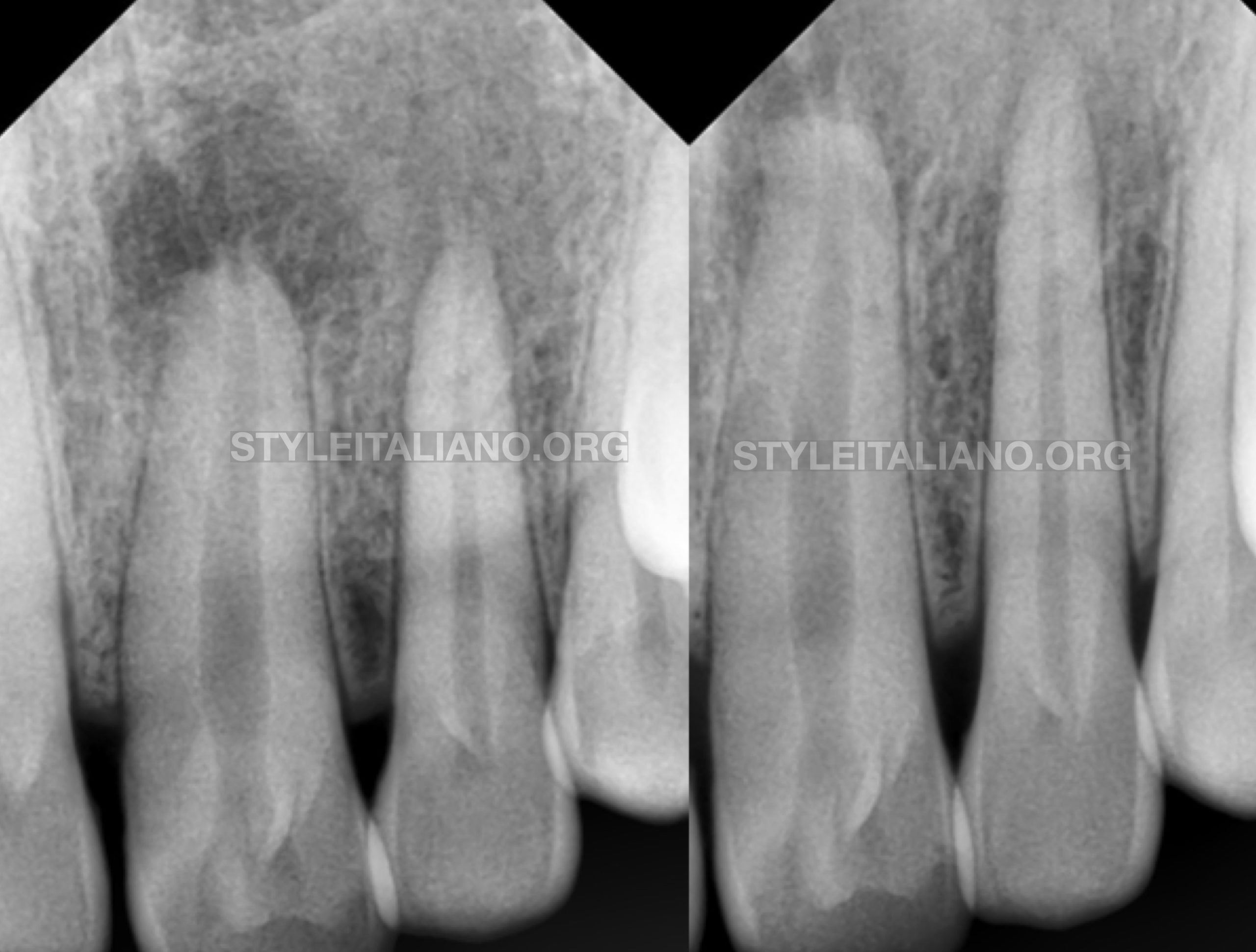 Efficient cleaning and proper sealing of root canals, the key to 