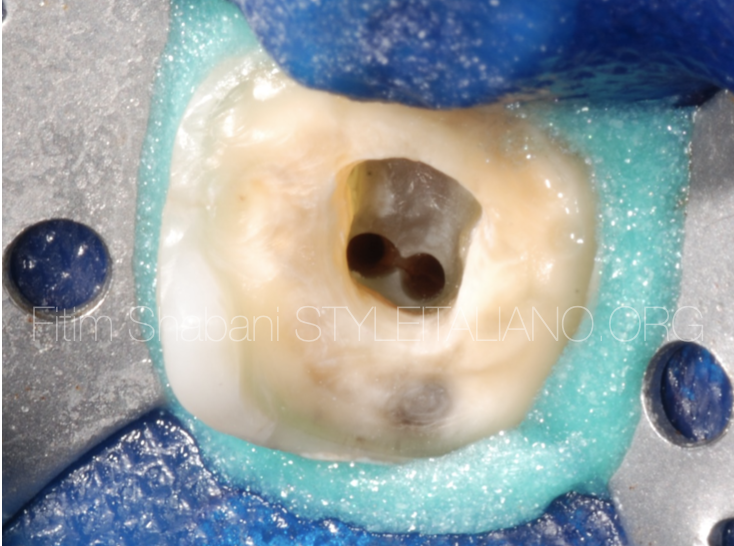 The importance of activation of irrigation in Endodontics