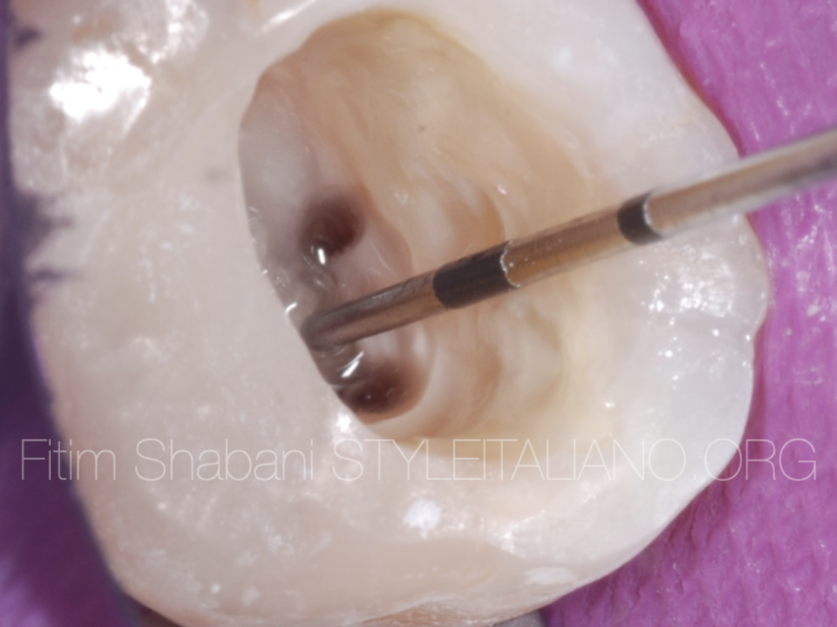 Controlled preparation of the Endodontic Access Cavity - Style