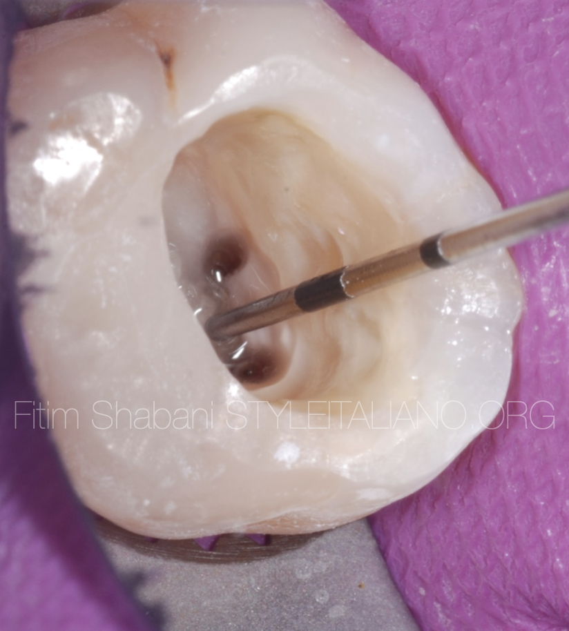Controlled preparation of the Endodontic Access Cavity
