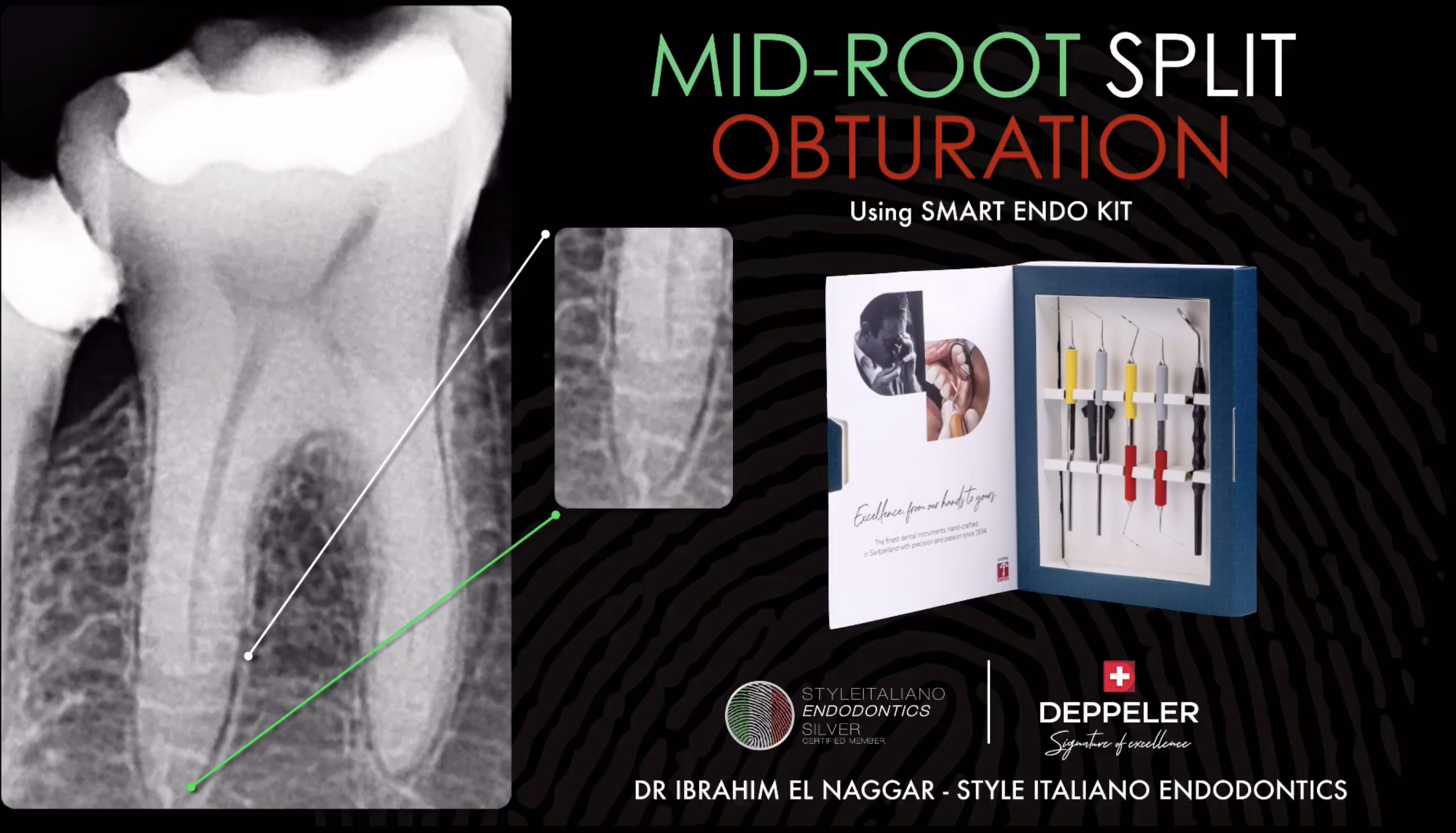 Mid-root split obturation using Smart Endo Kit