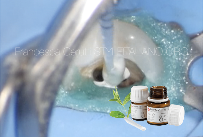 Endodontic treatment of a severely worn premolar