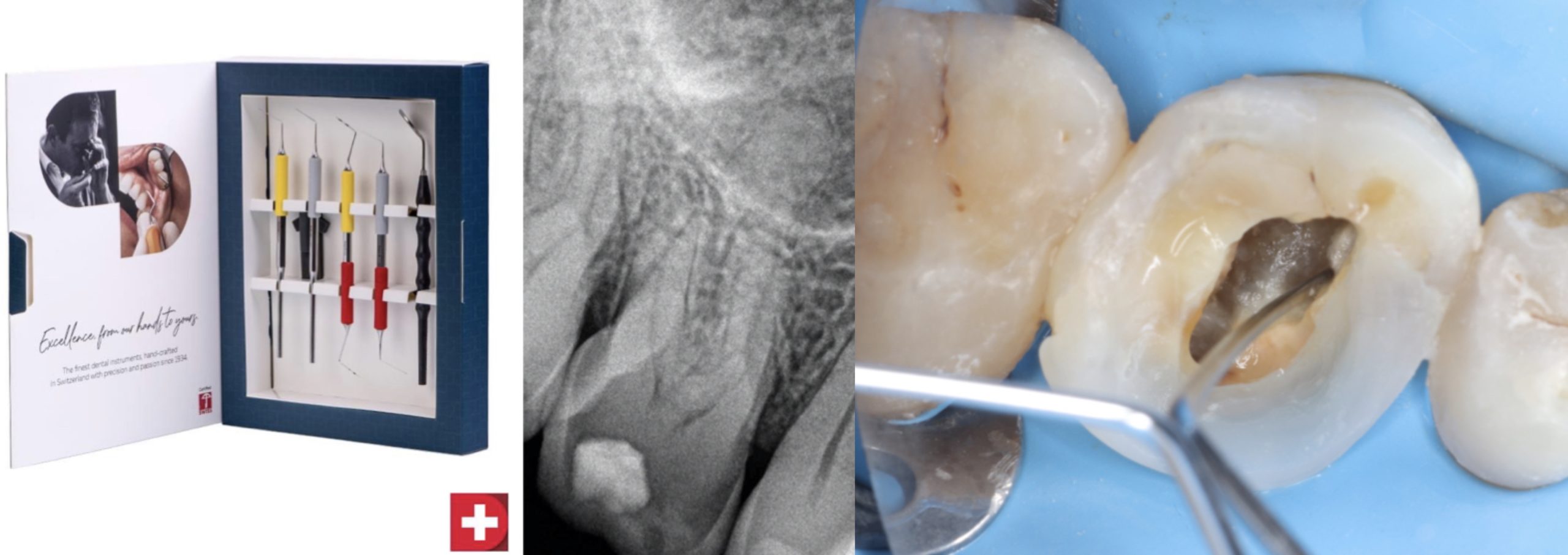Managing a slightly calcified maxillary molar:  Step by step with the Smart Endo Kit