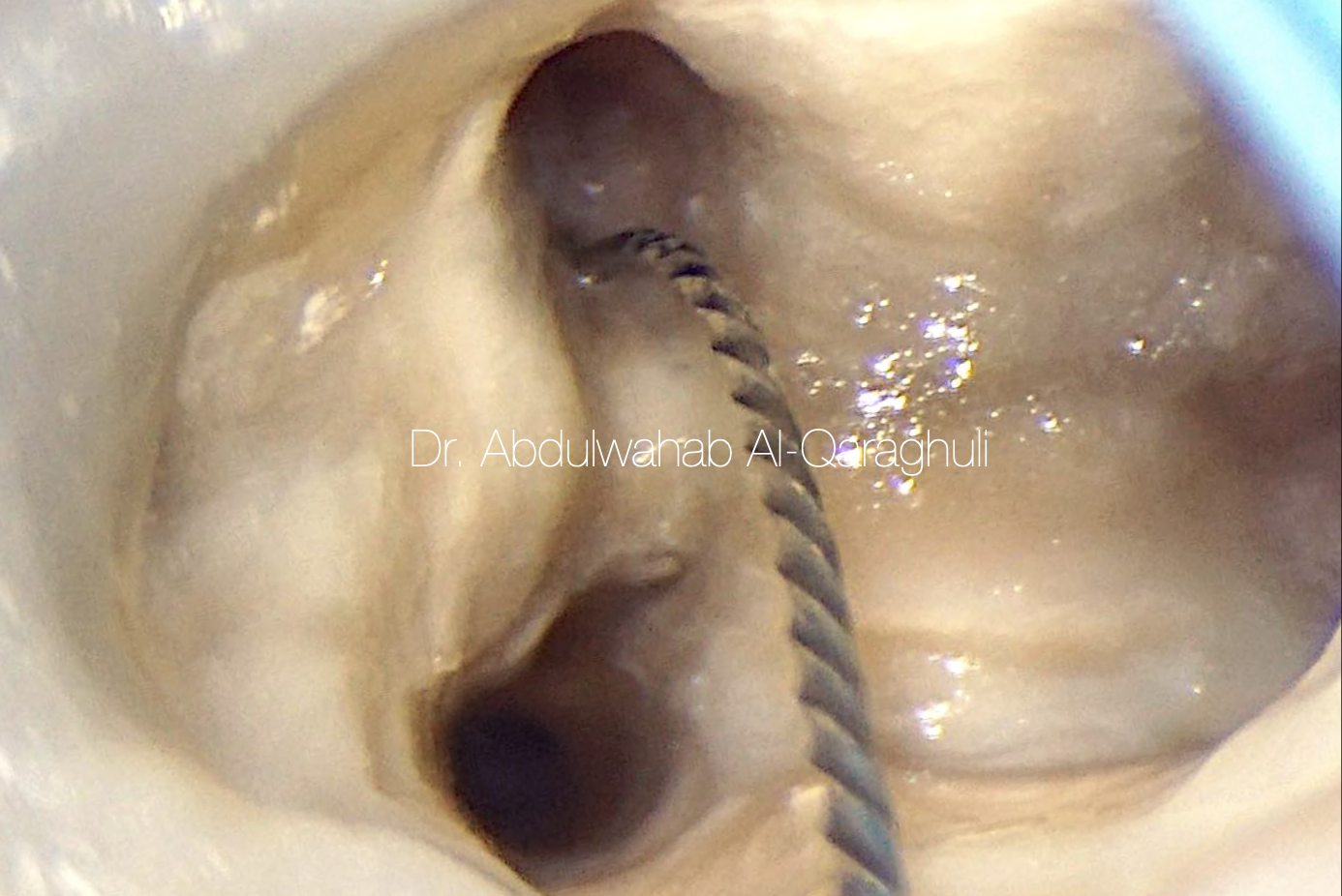 Management of Middle Mesial Canal in a lower Molar