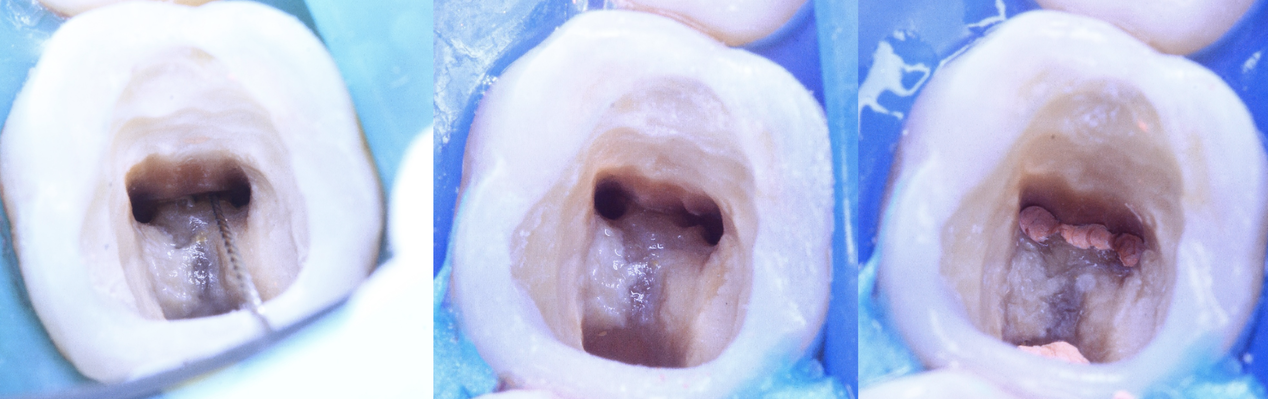 Middle Mesial Canal How to Detect it