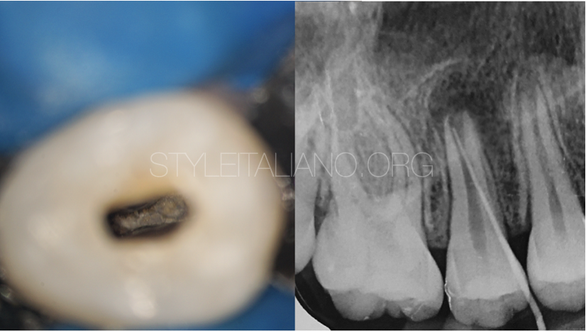 Immature tooth with apical periodontitis and sinus tract undergoes apexogenesis. A case report.