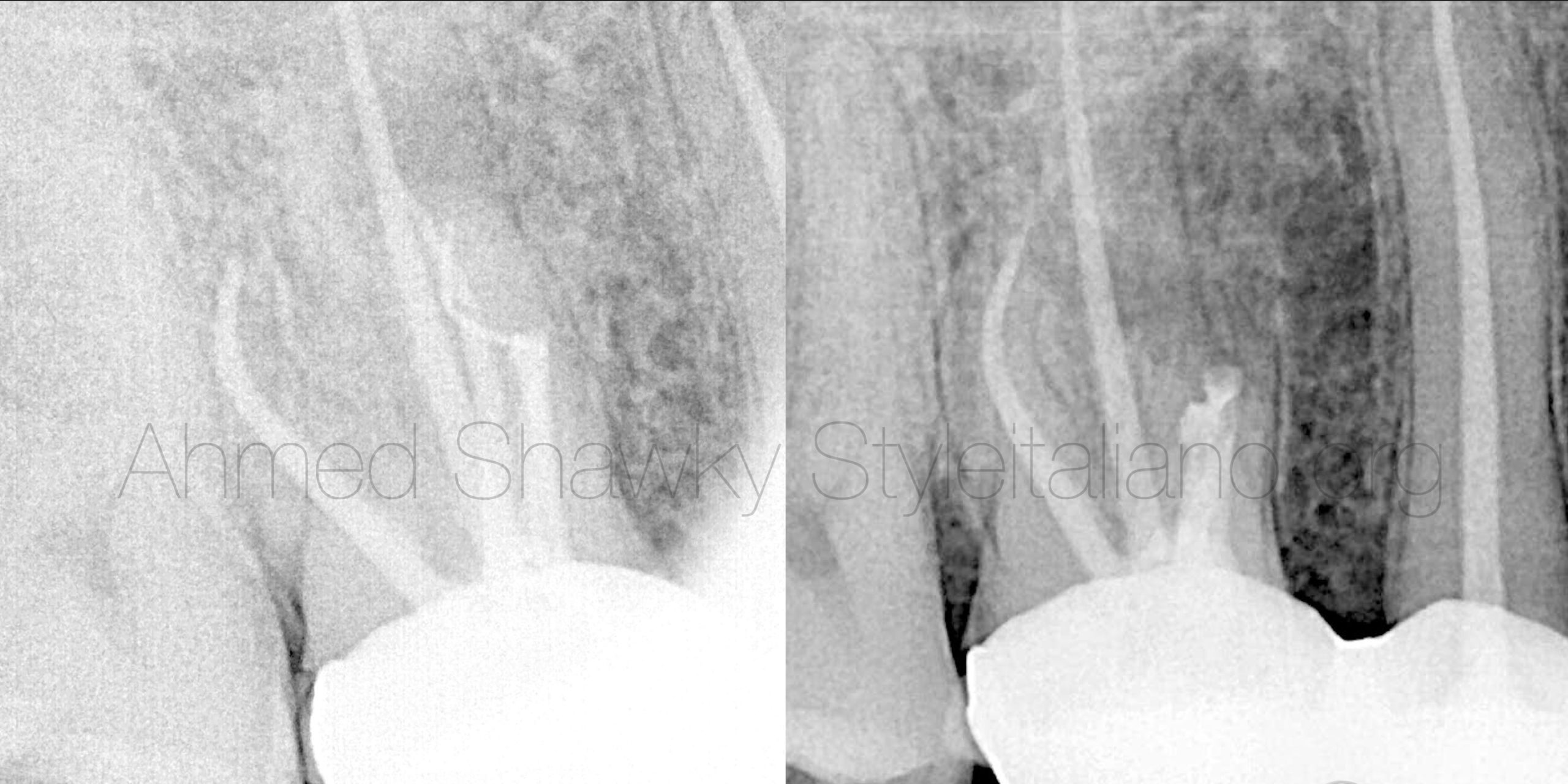 Apical Microsurgery for Conservative Management of a Broken File