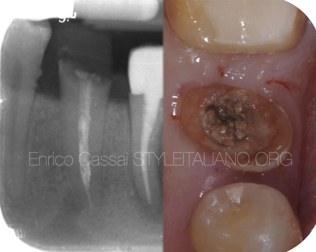 Removal of obturation material from the root canals: the correct use of ExtEndo