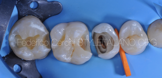 Cervical margin relocation of  endodontically  treated teeth