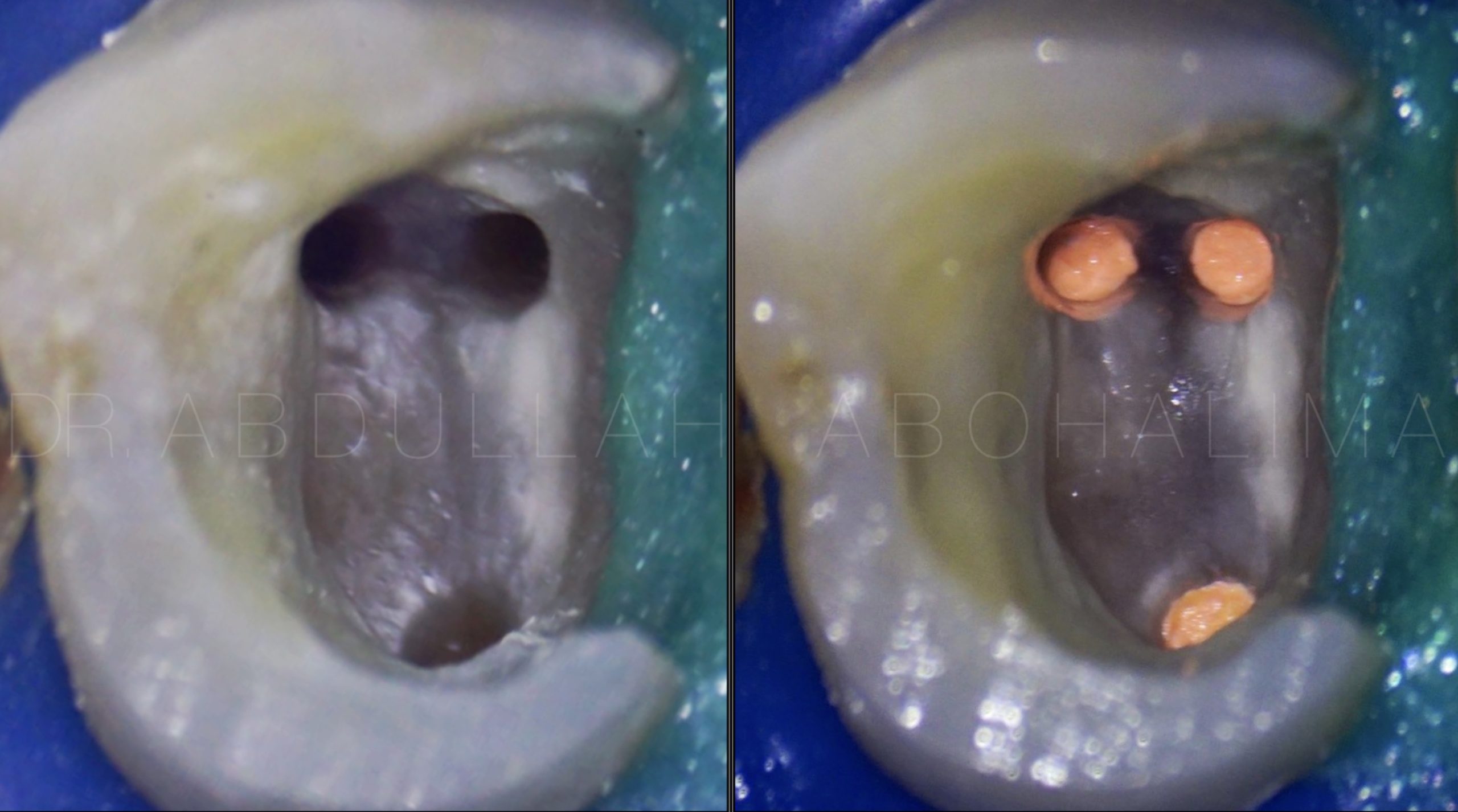 MOLARIZED  PREMOLAR  Management of three rooted premolar